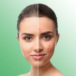 Acne Do’s & Don’ts – Stop These Mistakes!