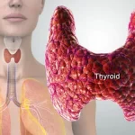 Thyroid Disorders: Symptoms and Treatment Options